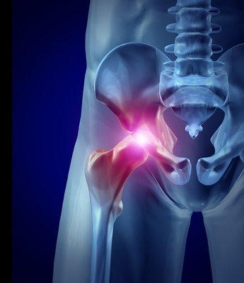 hip replacement alternatives in Orlando