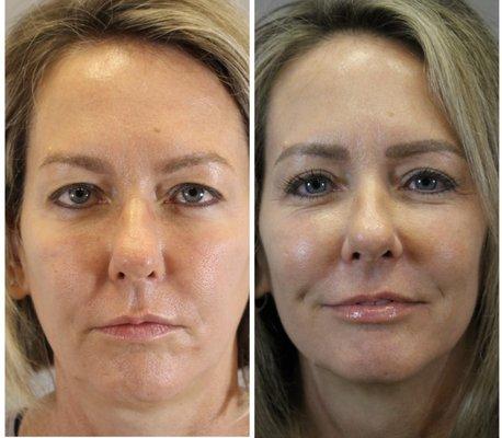 Before and after upper eye lid surgery and entire face CO2 laser.