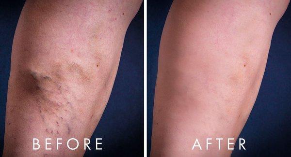 Dr. Taghizadeh has been performing vein treatments / removals on patients for several years. Find customized solutions at San Diego Varicose