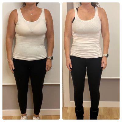 Before and After Semaglutide Weight-loss injections