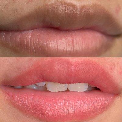 Lip Correction, Lip Blush