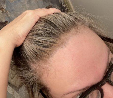 Brassy, blobbed hairline