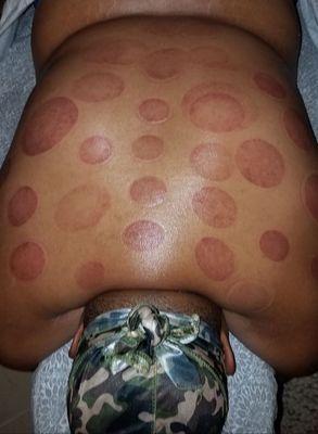 Cupping massage