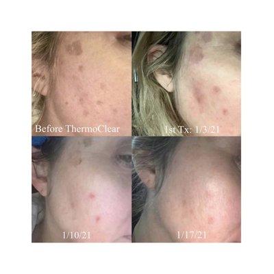 ThermoClear sunspot removal