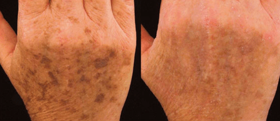 laser on hands pigmented Lesion 5 Treatments before & after