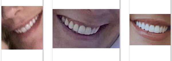 My natural teeth, Dudzik's work, repairs (what veneers should look like)