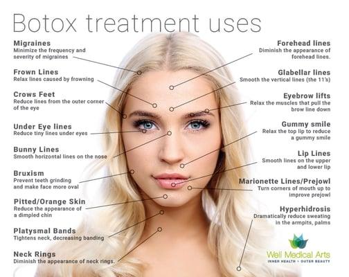 http://www.wellmedicalarts.com/botox/