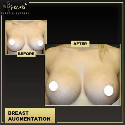 Breast Lift Miami - The Secret Plastic Surgery