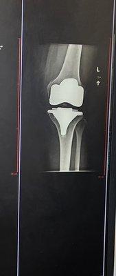 My new knee