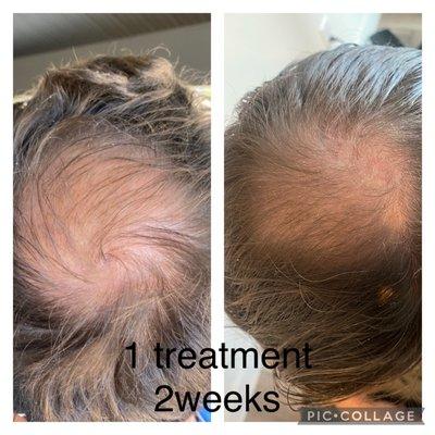 Before and after Hair rejuvenation (microneedlng)