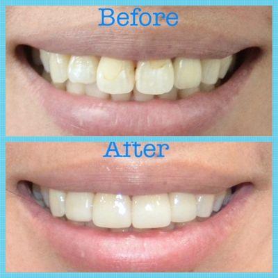 Before and After porcelain veneers, smile makeover !