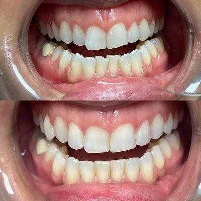 Before and After Invisalign Treatment. Approx 7 months to fix the crowding.