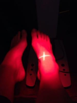 Lazer treatment on right foot