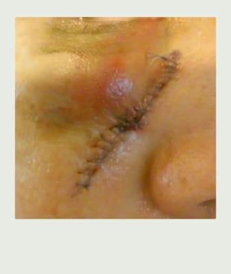 After my mohs surgery lost count how many stiches