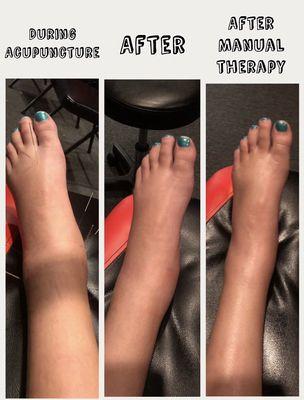 Results after 1 treatment with Dr. Ryan. This athlete walked out of our office on this ankle the first day!!