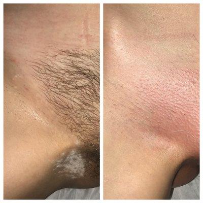 Before and after of a brazilian wax