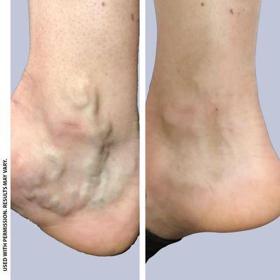 Before & after varicose vein treatment on the ankle.