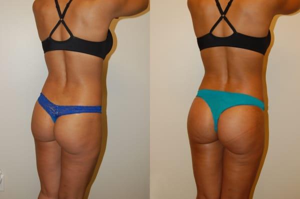 Buttock Augmentation with Implants