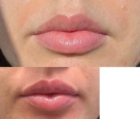 Before and after lip filler.