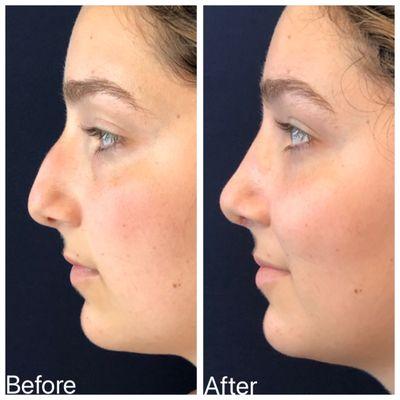 Before/after rhinoplasty