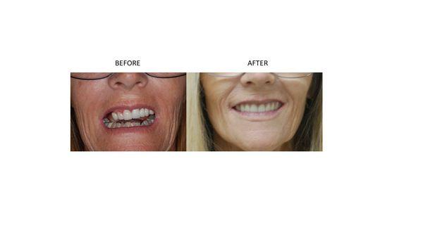 New smile with dental implants!