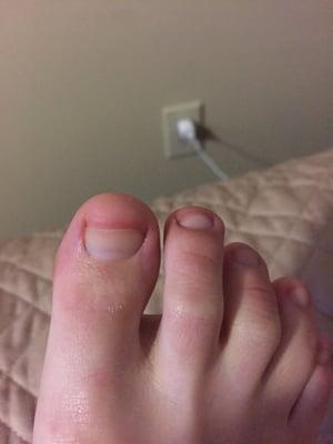 Toenails too short and painful