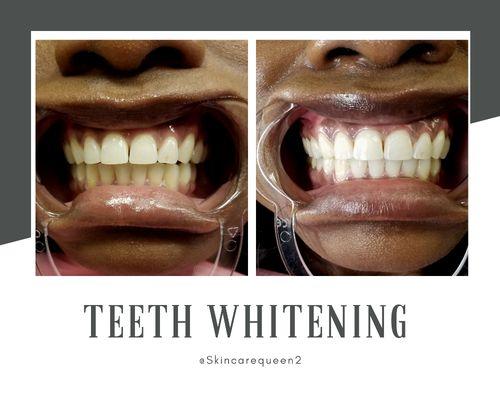 Teeth whitening / before & after