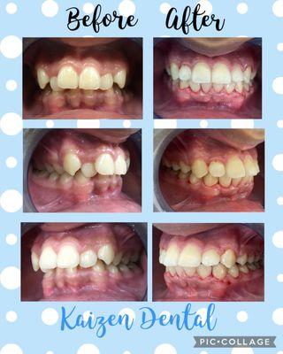 Severe crowding and tongue thrust
Patient was under 2 years of orthodontic treatment with functional re-education