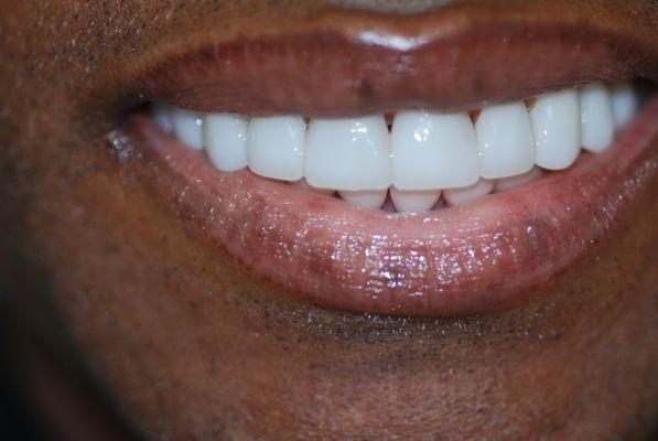 After Upper and Lower Veneers