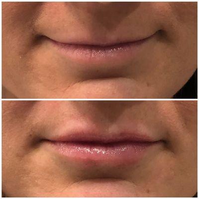 Lip plumping with Volbella filler