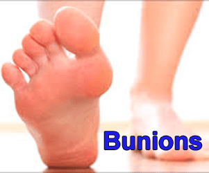 Bunion begone!