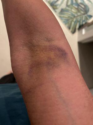 My bruised arm 3 days after what was supposed to be a simple blood draw at Quest in Pembroke Pines.