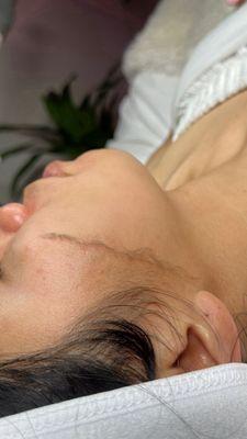 Dermaplane facial revealing smooth and rejuvenated skin