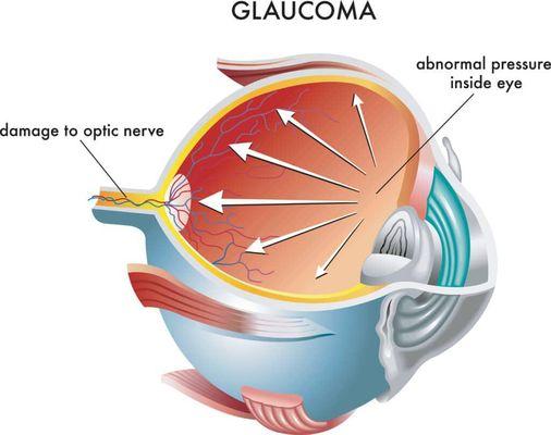 glaucoma eye diagram