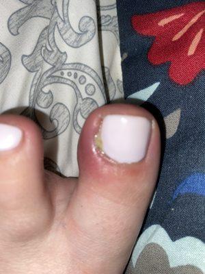 Toe infection because of pedicure