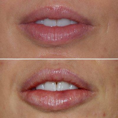 Lip Enhancement with Restylane Kysse