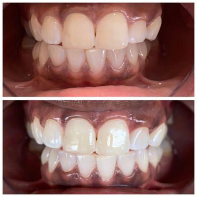 Teeth whitening in only 80 minutes. Comfortable and effective.