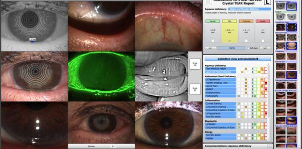 Ocular Surface Disease - Crystal Tear Report for patient's