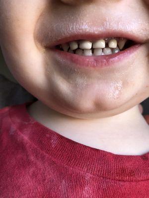 The two teeth on either side of his very two front were almost ground to the gum line and they capped them so he has teeth back now!!