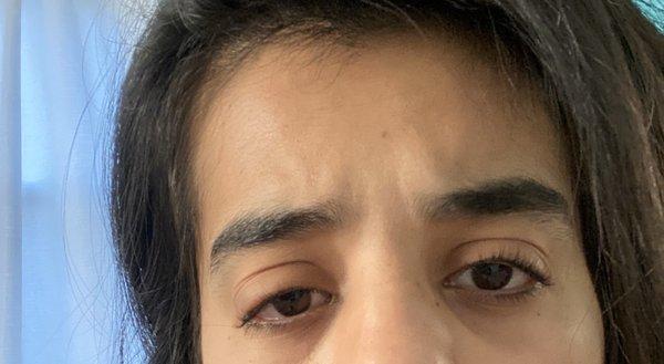 Right eye infection