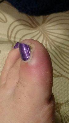 Infected toe and bad pedicure. Don't go here!