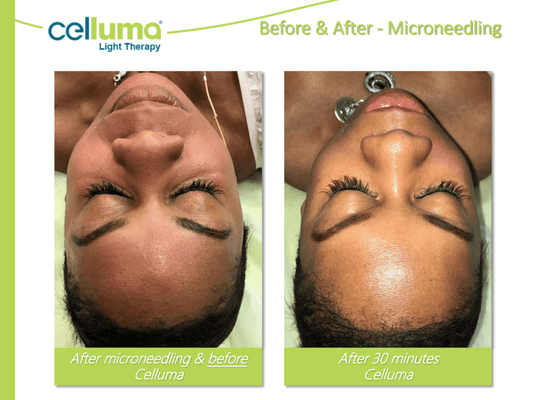 Glowing radiant skin after 30 min of Celluma Light and Microneedling. Similar results after Microdermabrasion Treatment + Celluma!