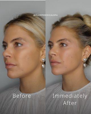 Correction of Jawline, nasolabials and temples with filler