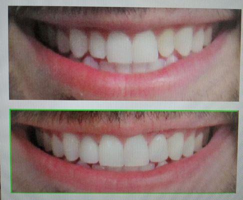 Before I got my veneers & after I got my veneers.