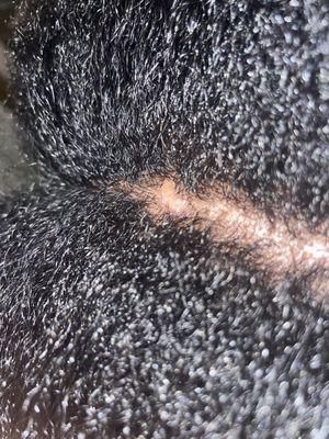 Lesions on scalp