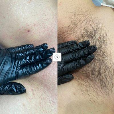 Brazilian Wax - Before/After