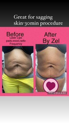 Nonsurgical laser Lipo treatment. No pain, great for business clients who want quick results. Treatment time 45min.