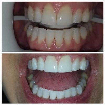 This is a before and after of one of our Zoom! Whitening cases. You can see how great this product works!