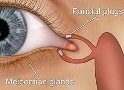 Punctal plugs in drainage canals of the eyelid.