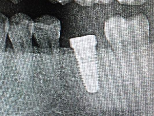 My new implant - post procedure Xray.